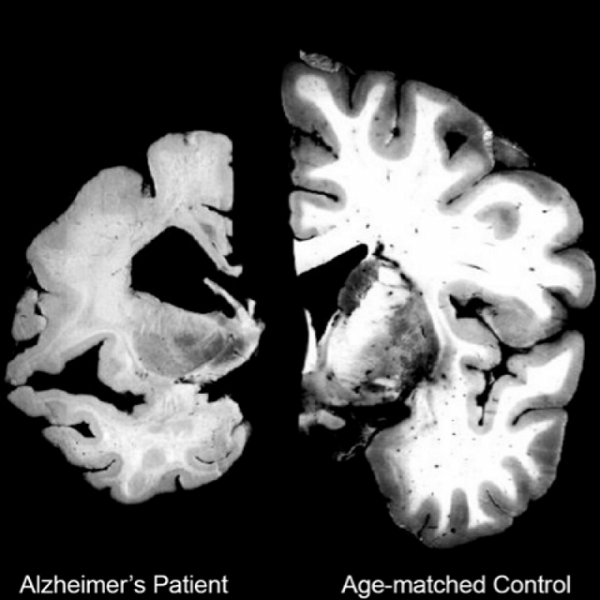 Alzheimer's Disease. The Genetic Link And DNA Testing For The Inheritance.