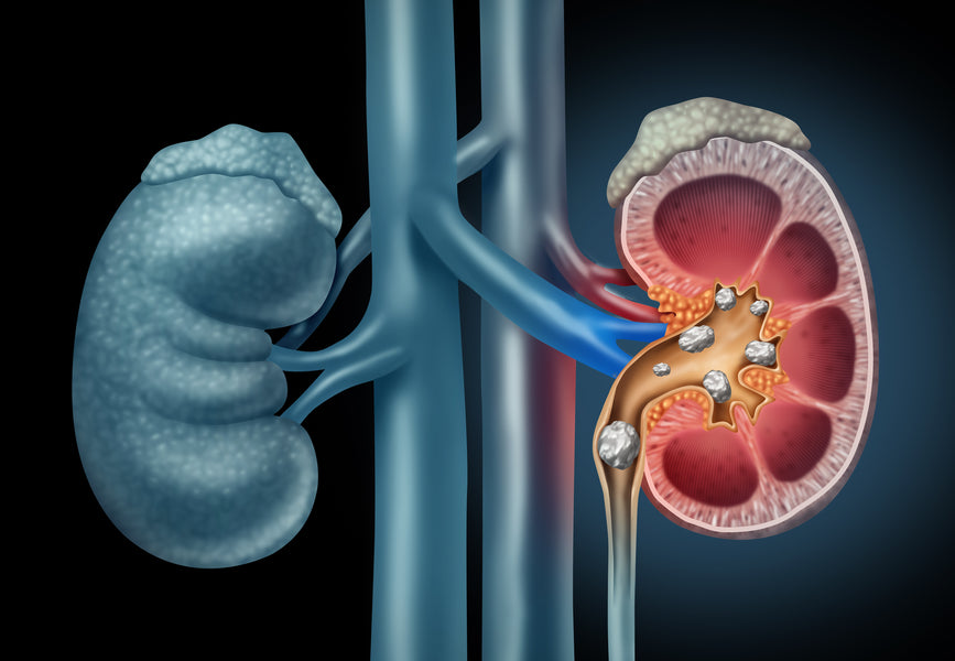 Hereditary Kidney Stones. The Genetic Link And The Role Of Whole Exome Sequencing.